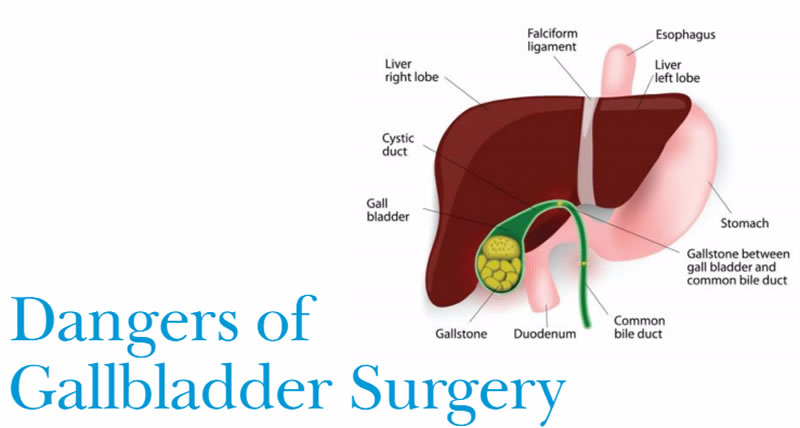 Calot Triangle In Cholecystectomy Diet Changes